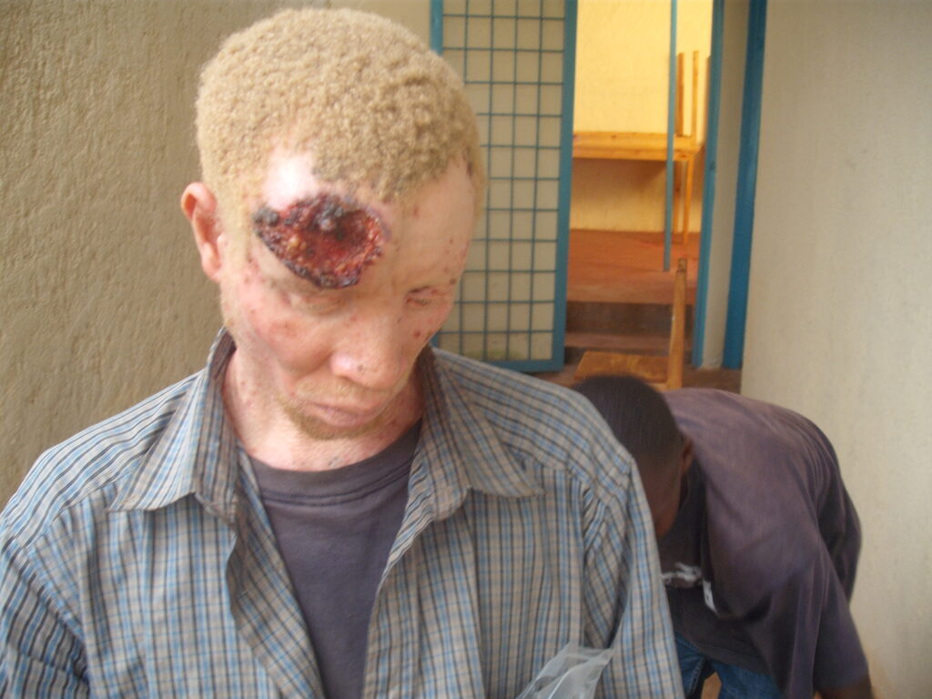 Skin Cancer Care